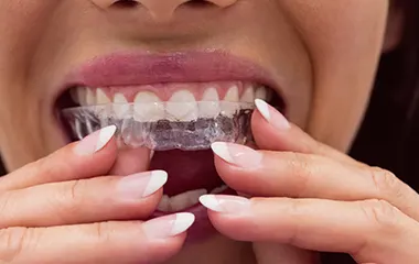 invisible aligners | Pestana Dental & Aesthetics