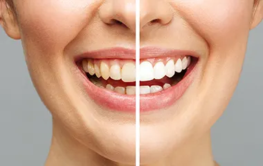 teeth whitening | Pestana Dental & Aesthetics